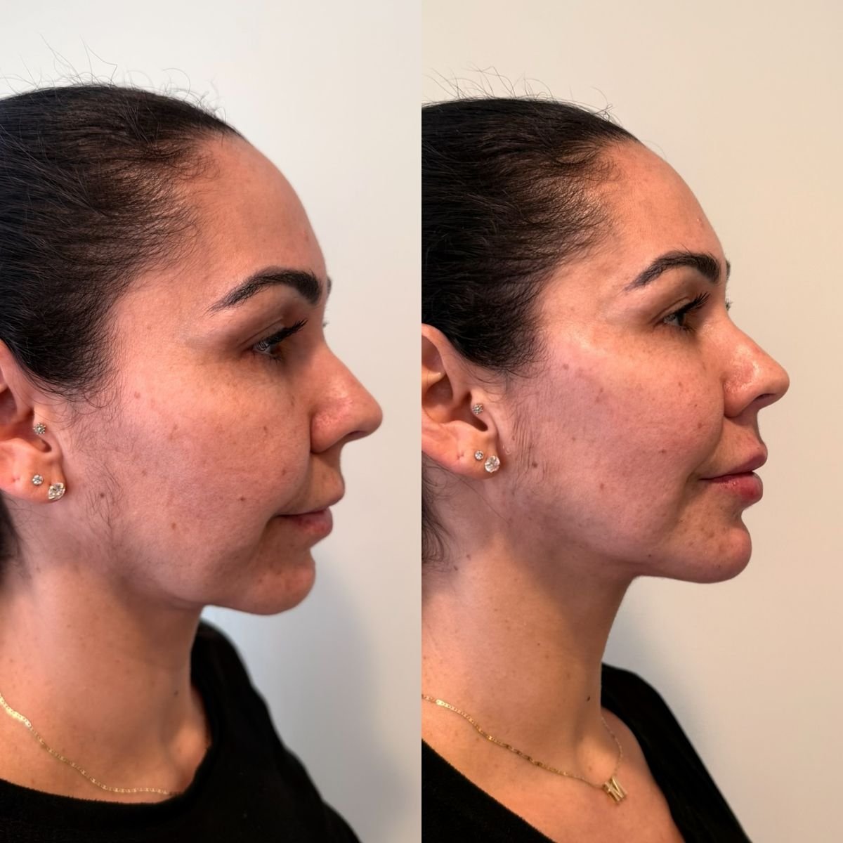 Avant/Après Duo Brosse LuméaSkin — ovale du visage redessiné et raffermi
