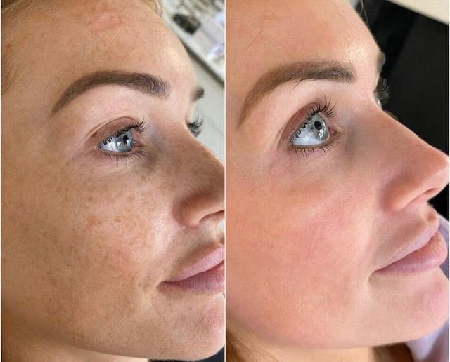 Avant/Après Medicube TXA Niacinamide — taches atténuées en 4 semaines