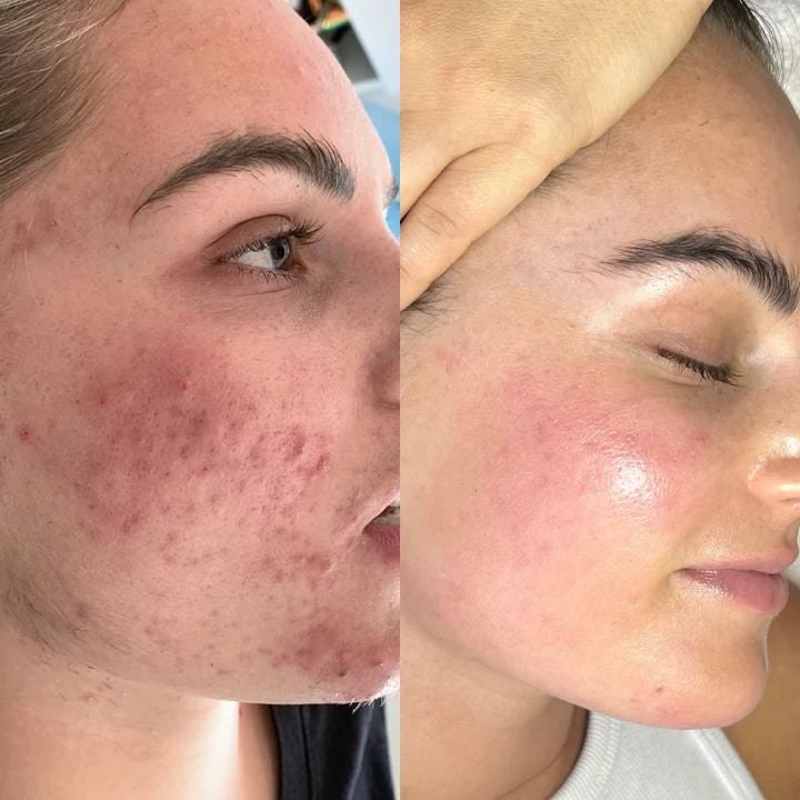 Avant/Après SKIN1004 Centella — peau apaisée et rougeurs réduites en 7 jours