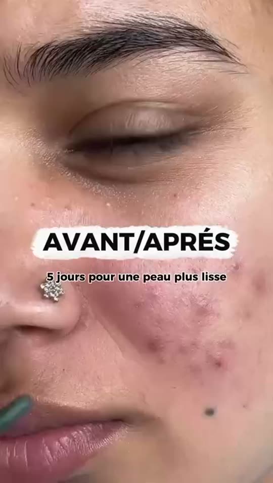 Témoignage cliente LuméaSkin